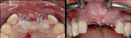 Advanced surgical techniques for flap management during implant placement
